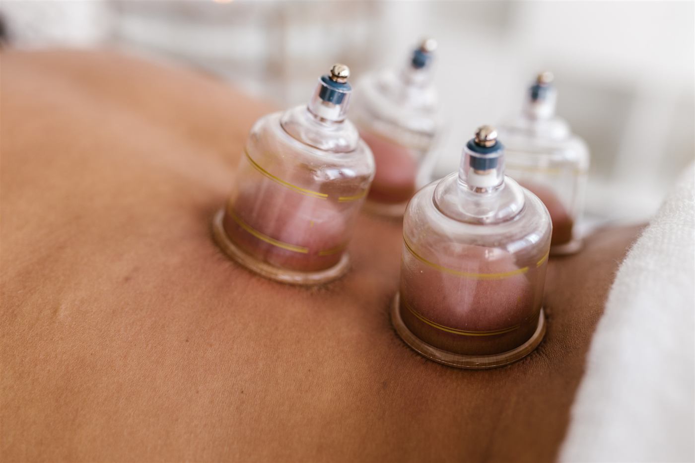 Cupping therapy on a patient's back