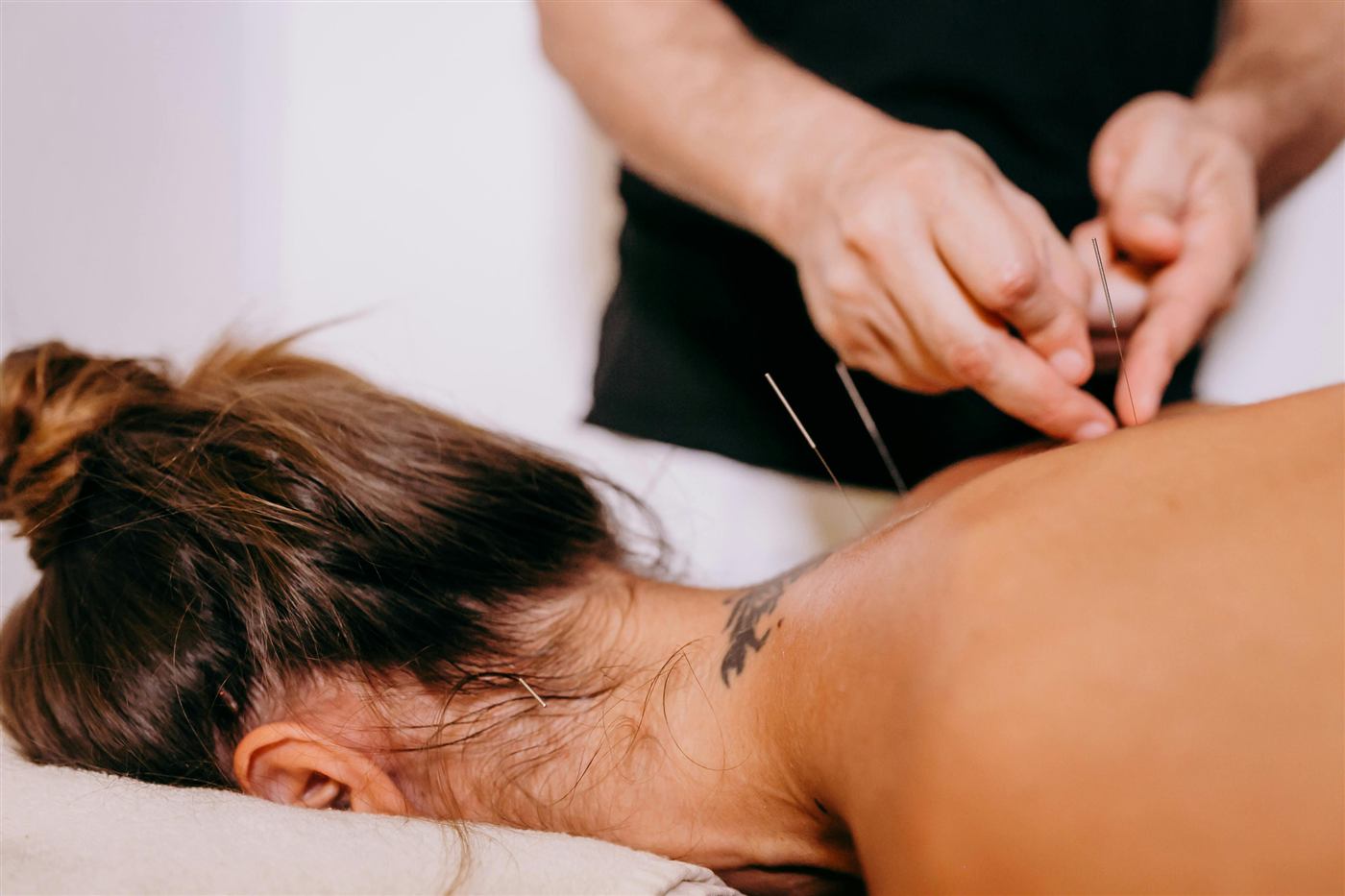 Dry needling treatment along the shoulder and neck